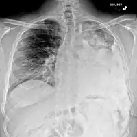 Metastatic osteosarcoma to the left chest