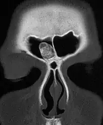 CT-scan skull: Osteoma of the frontal sinus