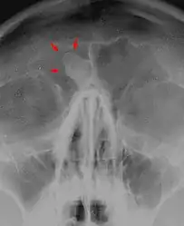 X-ray skull: Osteoma of the frontal sinus