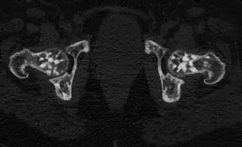 Osteopoikilosis of the hips on CT.
