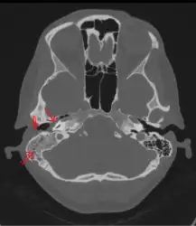 CT scan: Otitis media (simple arrow) and mastoiditis (double arrow) of the right side (left side in image). The external auditory canal is partially occupied by suppuration (triple arrow). 44-year-old woman
