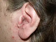 Exudate over a background of redness on the external ear canal of an adult