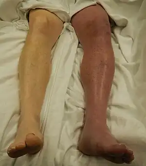 A case of phlegmasia cerulea dolens in the left leg