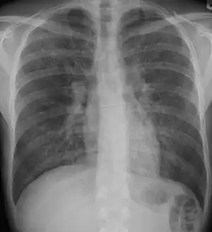 Pneumocystis pneumonia can present with interstitial lung disease, as seen in the reticular markings on this AP chest x-ray.