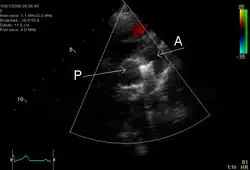 An echocardiogram of a coiled persisting ductus arteriosus: One can see the aortic arch, the pulmonary artery, and the coil between them.
