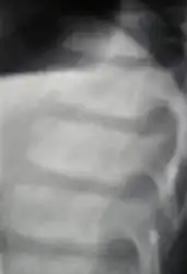 Lateral spine radiograph showed platyspondyly associated with anterior clefting of the vertebrae.
