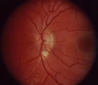 Right fundus with small coloboma at the inferior edge of the nerve that is vertically elongated.