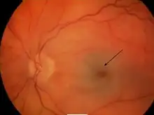 Cherry-red spot with retinal pallor typical of central retinal artery occlusion