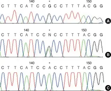 Wiskott-Aldrich Syndrome-a) Normal control b) sequencing identification of  missense mutation in exon 2 of  WAS gene, single base "G" to "A" substitution causing replacement of arginine by histidine c)  WAS exon 2 sequence in female heterozygotes