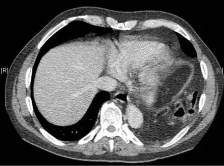 Axial lower chest CT scan showing bowel herniation due to left diaphragmatic rupture