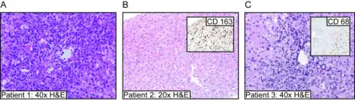 a-c)Liver biopsy results for three individuals with  acute hepatitis (and SJIA)