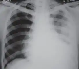 Chest radiograph displaying inhomogeneous opacification of the left half of the chest that is fibrothorax