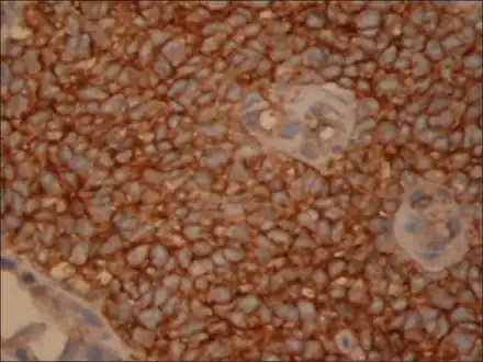 Tumor cells show membrane positivity for MIC-2, suggesting a primitive neuroectodermal tumor