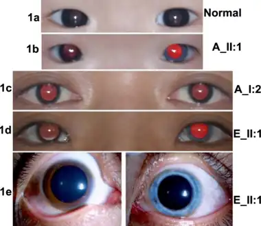 a-e)Images of eyes from WS1 individuals and controls