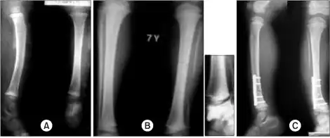 a)Radiographs show a large segmental fibular defect by chronic osteomyelitis  b,c) four years later, serial radiographs show a valgus deformity of  ankle due to upward migration of  distal fibula