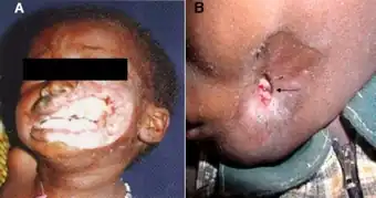 a. Rapidly destructive and fulminatingdisease requiring lengthy antibiotic treatment prior to surgery.  b. Arrested advanced disease requiring short course of antibioticsbefore surgical reconstruction (arrow indicates sequestrumformation)