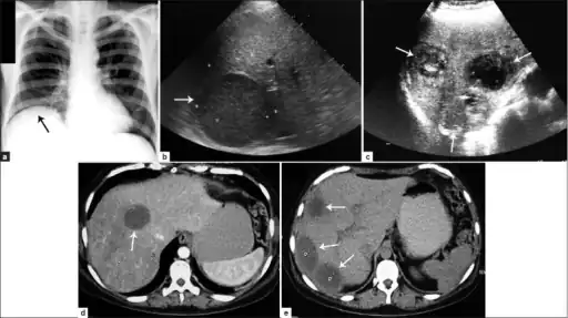 a) Amoebic liver abscess showing the elevation of the right hemi-diaphragm b)single large amoebic abscess and c) three amoebic hepatic abscesses. d) Contrasted computed tomography (CT) scan of a single abscess and e) three clear amoebic liver abscesses