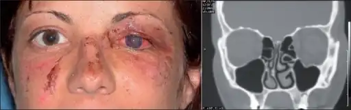 a) Image showing post-traumatic cataract of  left eye and b) coronal CT scan showing a blow-out fracture of left orbital floor