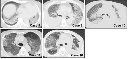 Chest CT images of five persons/cases who developed  acute interstitial pneumonia