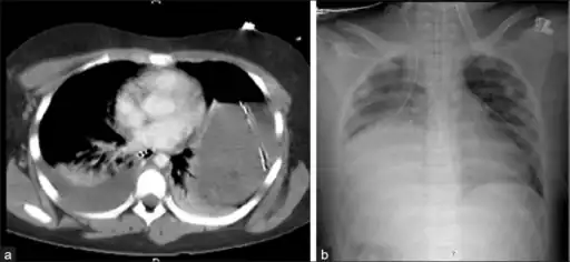 Bilateral blunt diaphragmatic rupture  a) confirmation of intrathoracic herniation indicates left hemidiaphragmatic rupture  b) post operative image shows elevation of  right hemidiaphragm adding suspicion of right diaphragmatic rupture