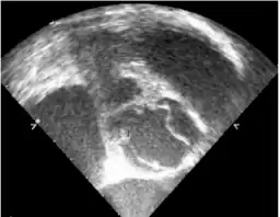 Transesophageal echocardiography- the right side commissure of the bicuspid aortic valve is ruptured