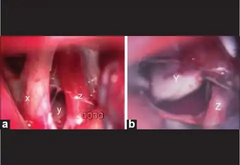a) Intraoperative image shows hypothalamic hamartoma identified between optic chiasma and internal carotid artery, b) Hypothalamic hamartoma being removed