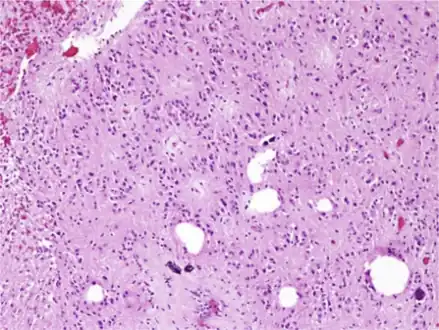 Characteristic clusters of nuclei in a dense fibrillary background suggestive of subependymoma