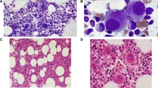 Myelodysplastic syndrome (with isolated del (5q))  a,b) Hypolobated megakaryocyte  c,d)hypercellular bone marrow with myeloid proliferation associated with hypolobated
