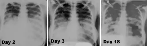 Image -primary pneumonic plague obtained on illness days 2, 3, and 18 shows bilateral lower lung zone predominant airspace disease associated with bilateral pleural effusions