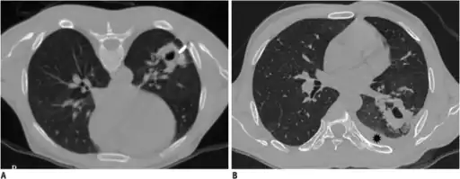 Development of hemothorax following lung lesion biopsy