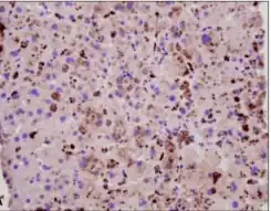 Immunohistochemical staining of liver biopsy specimen, strong cytoplasmic staining for hepatitis A virus antigen was noted