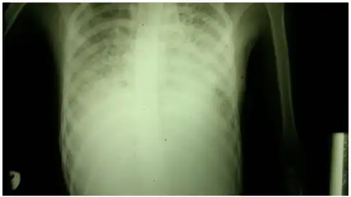 Chest radiograph showing interstitial lung disease
