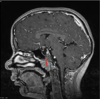 Empty sella- MRI Scan of the brain, sagittal T2-weighted