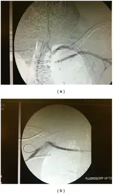 Restoration of flow in the left subclavian artery across a propaten graft from the right subclavian artery.