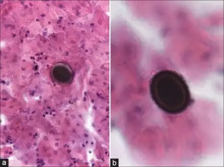 a,b)Taeniasis in a conventional Pap test