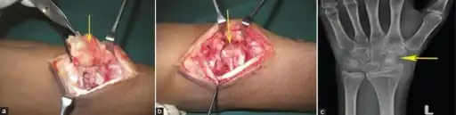 a, b) Intraoperative -shows the exuberant synovitis  and the site of cortical perforation with extruding granulation tissue  c) post-excision radiograph of wrist