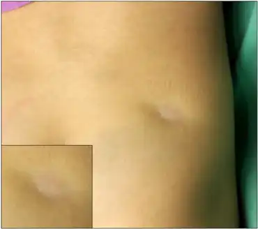 Hypopigmented, and depressed atrophic patch on right buttock.