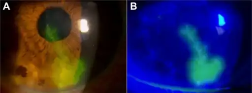 a) Dendritic corneal lesion b) lesion shows hyperfluorescence under cobalt blue light.