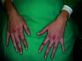 Umbilicated erythematous papules with adherent central keratotic plug on the dorsum of the hands