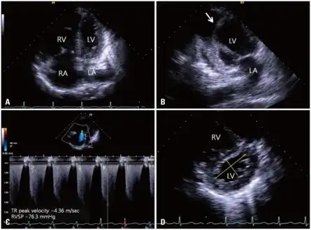 a-d)2DE (two dimensional echocardiography) features of cor pulmonale