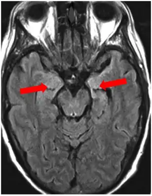 Image of limbic encephalitis (and positive NMDAR antibodies in the CSF)- increased signal intensity is seen in the bilateral medial temporal lobes and hippocampi.