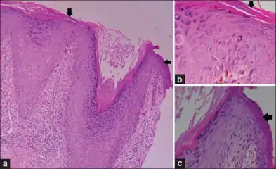 a) Focal parakeratosis b,c) prominent parakeratosis