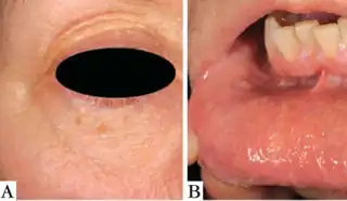 Cowden syndrome- a) yellowish papules around  eye b) papular lesions on the lips