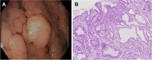 a)Pedunculated adenoma,  b) photomicrograph of the same polyp showing an adenoma with low grade dysplasia