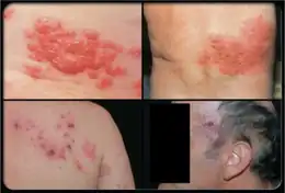 Images of Herpes zoster (shingles) rash