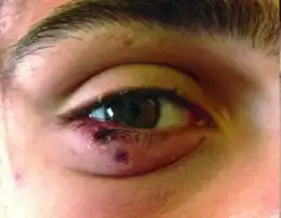 Palpebral eschars caused by Rickettsia sibirica mongolitimonae infection