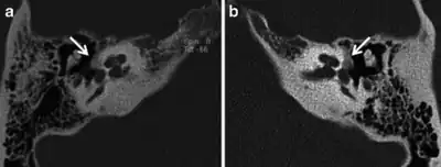 Images of the right a) and left (b) hypodense demineralised plaques arrow consistent with fenestral otosclerosis