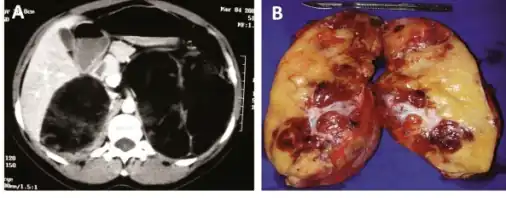 a)CT scan showing heterogeneous bilateral myelolipomas b) macroscopic aspect of left adrenal myelolipomas