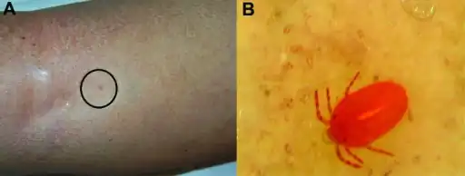 a) Clinical features and dermoscopy findings  b) shows a Neotrombicula autumnalis mite attached to skin