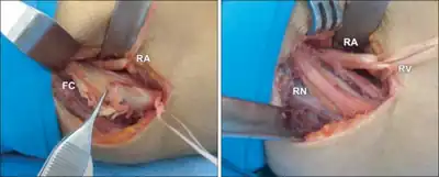 Surgery for radial neuropathy (RN) due to  fibrotic cord (FC)